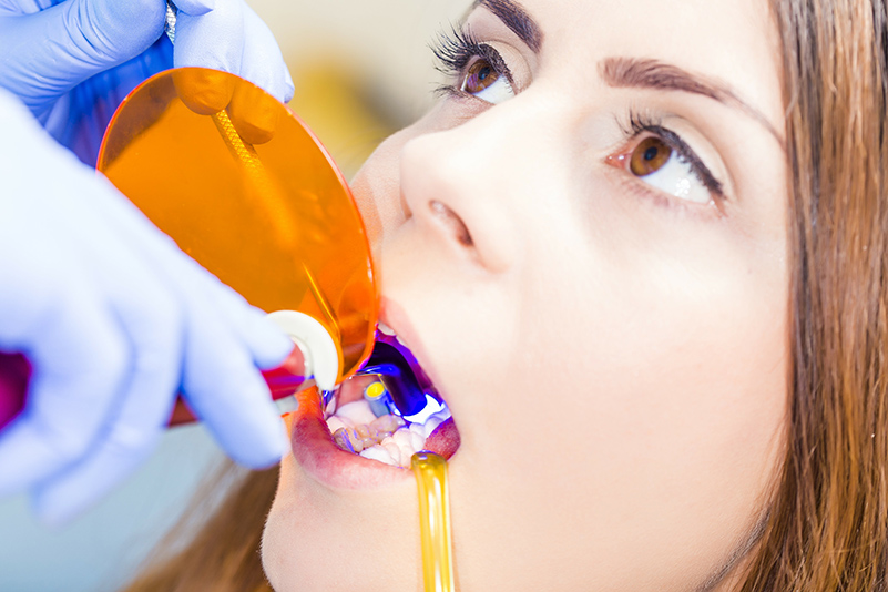 patient undergoing Dental filling procedure
