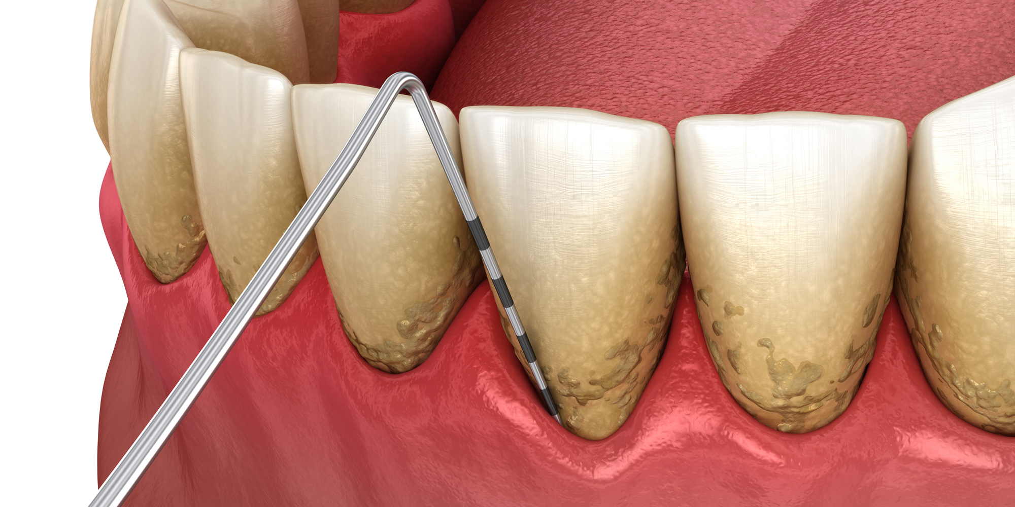 Periodontal disease model